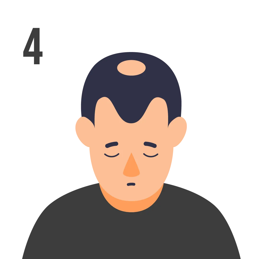 male pattern baldness norwood scale stage 4