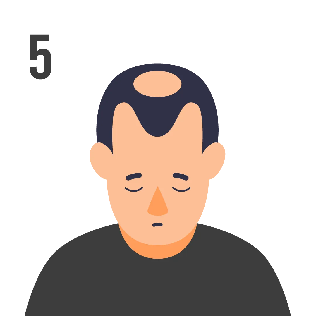 male pattern baldness norwood scale stage 5