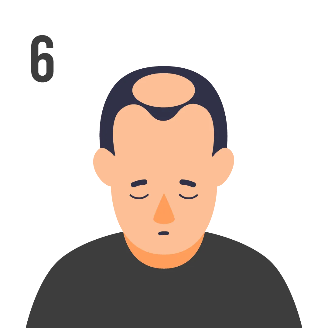 male pattern baldness norwood scale stage 6