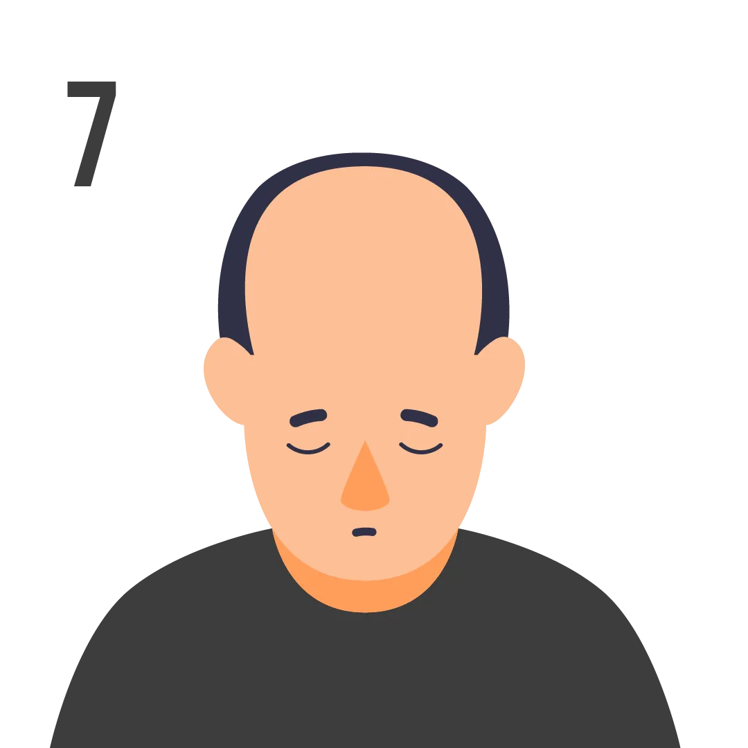 male pattern baldness norwood scale stage 7