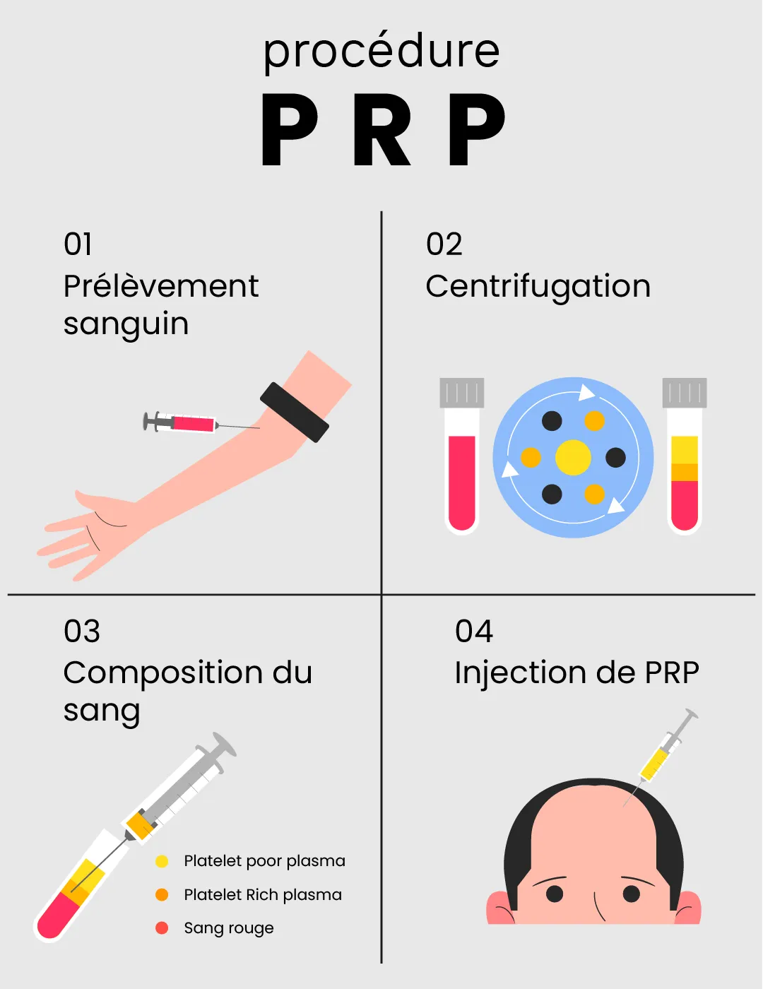 prp procedure 