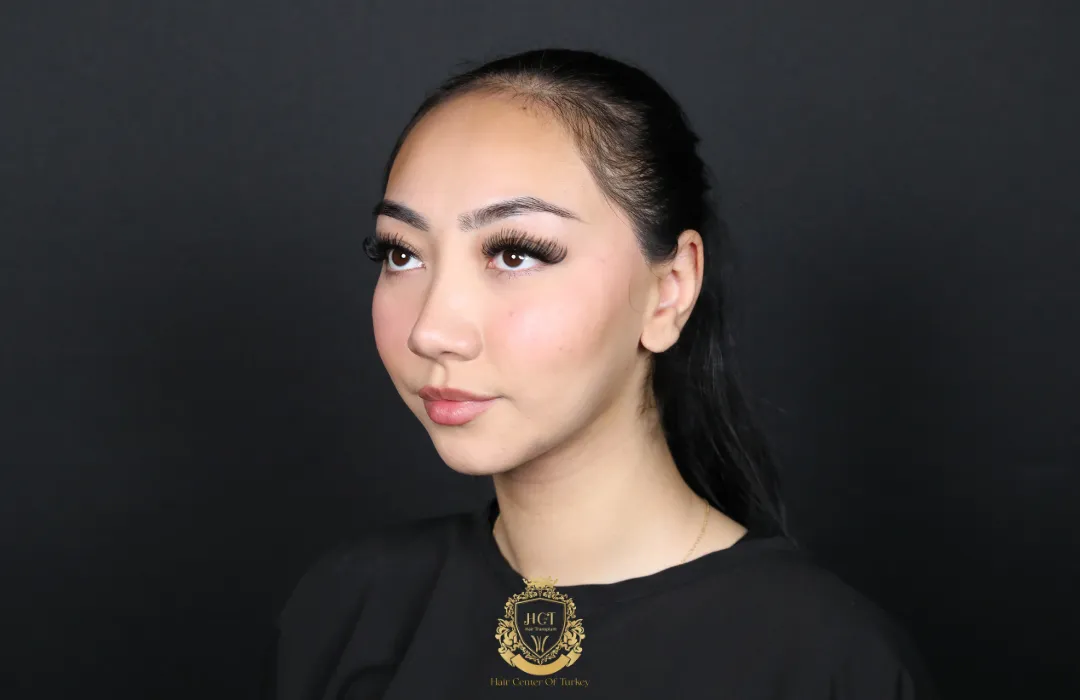 receding hairline womans
