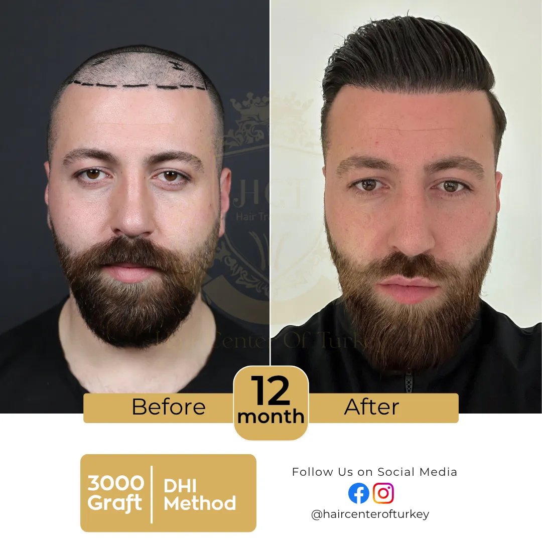 dhi hair transplant before and after images hair center of turkey