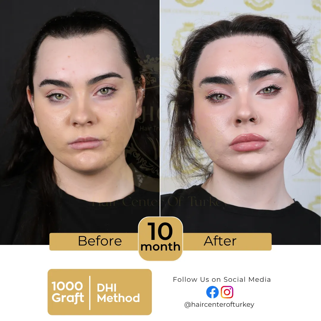 hair transplant before and after images hair center of turkey