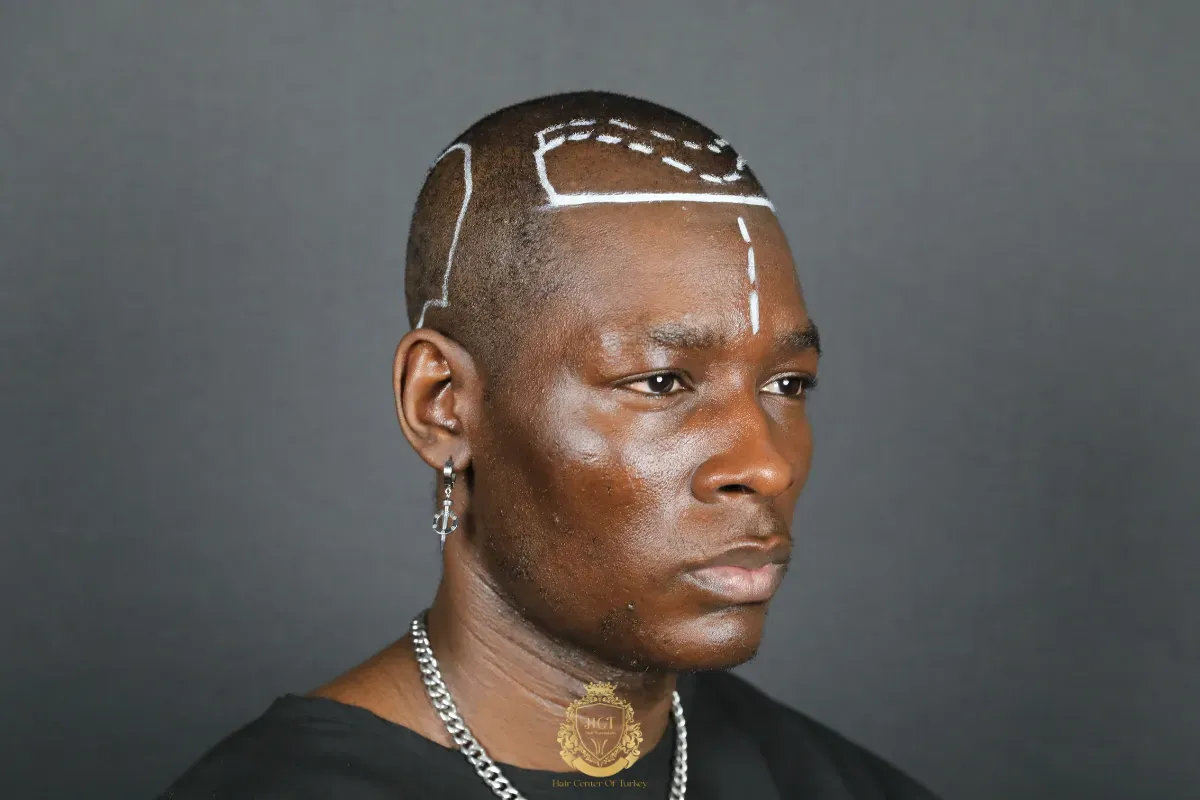 who is eligible for afro hair transplant turkey