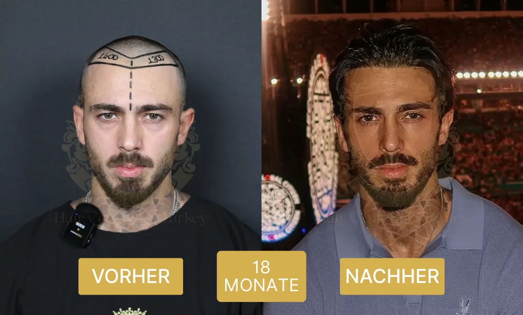 18 Monate Haartransplantation – Ergebnisse vor und nach der Behandlung