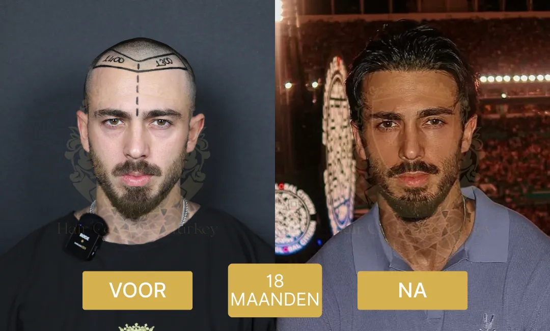 18 maanden haartransplantatie voor en na resultaten