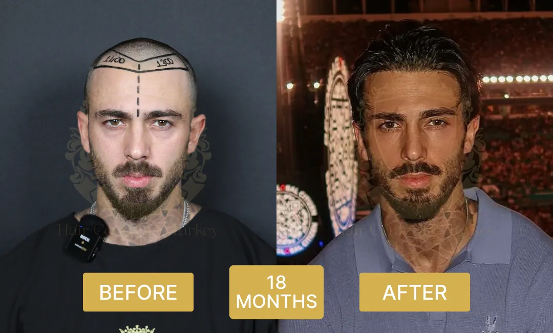 18 months hair transplant before and after results