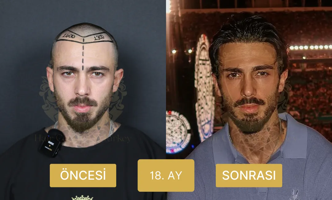 18. ay saç ekimi öncesi ve sonrası sonuçları