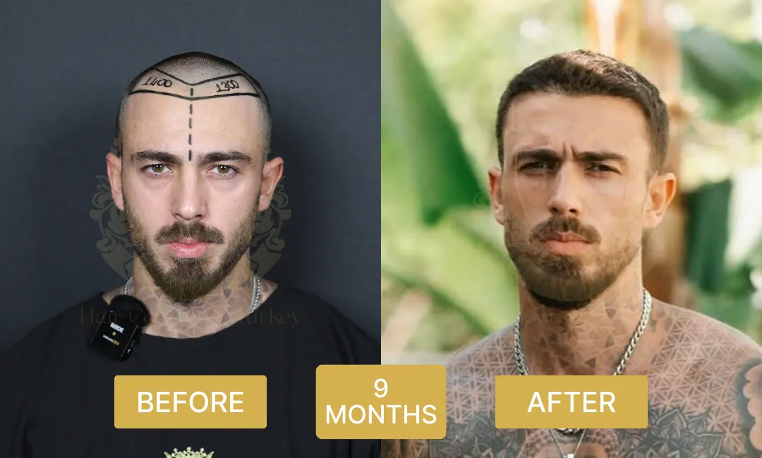 9 months hair transplant before and after results