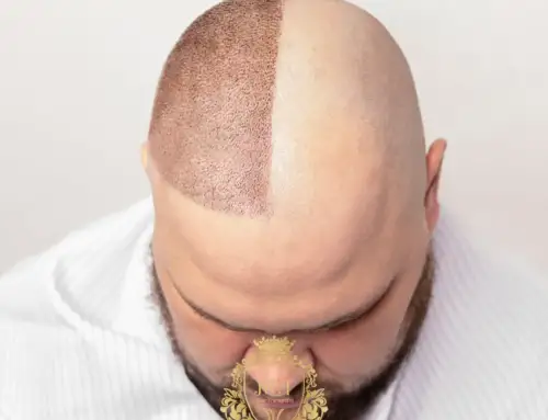 ¿Merecen la pena los trasplantes capilares o la gente se arrepiente de ellos?