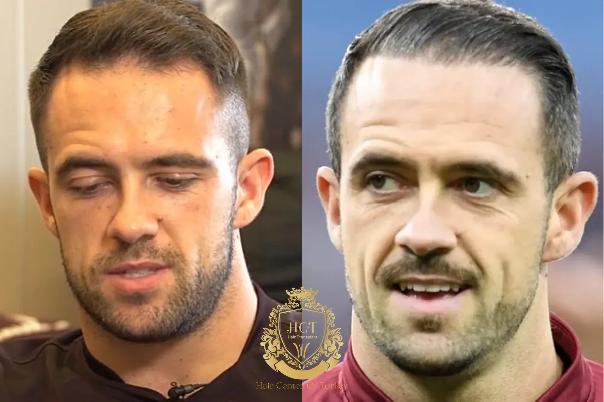 Did Danny Ings Have a Hair Transplant F