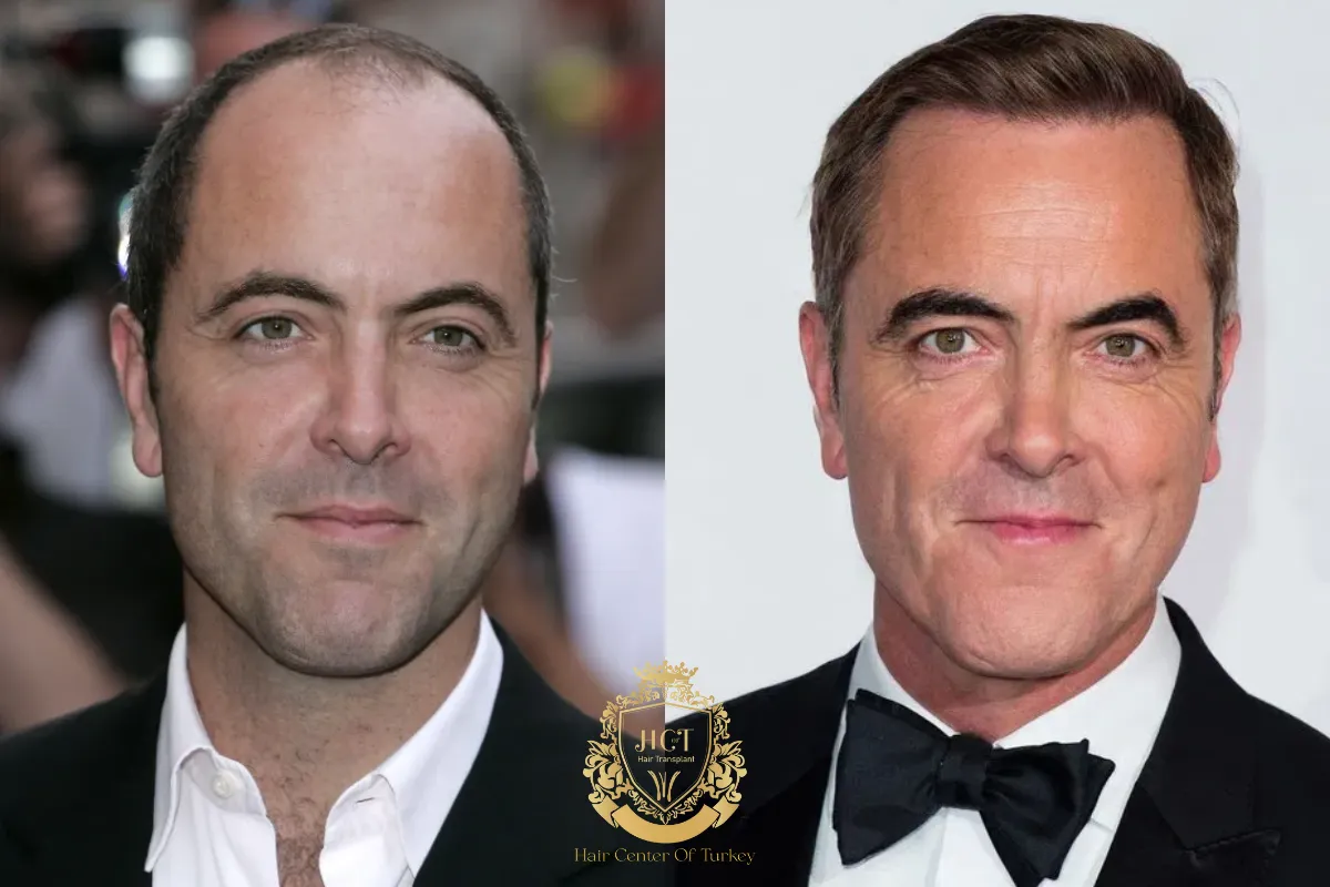 Did James Nesbitt Have a Hair Transplant 2