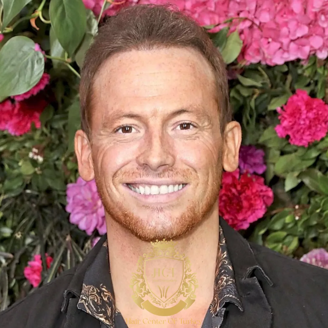 Did Joe Swash Have a Hair Transplant F