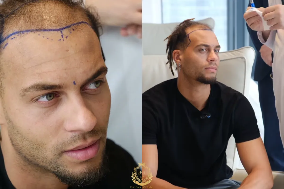 Did Ouzy See Get a Hair Transplant 2