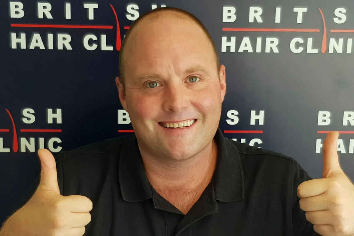 Did Peter “Tubes” Dale Have a Hair Transplant 1