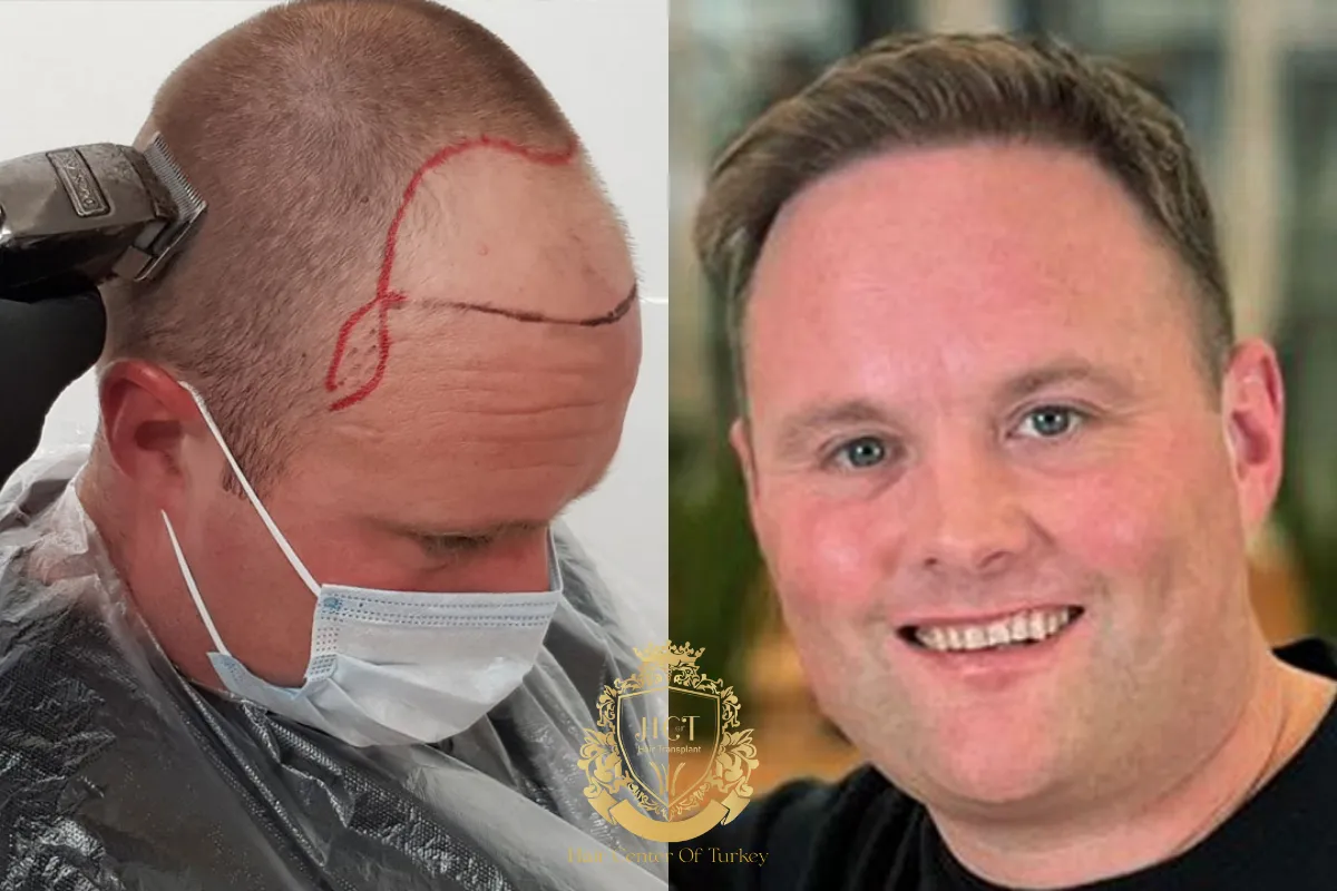 Did Peter “Tubes” Dale Have a Hair Transplant 2