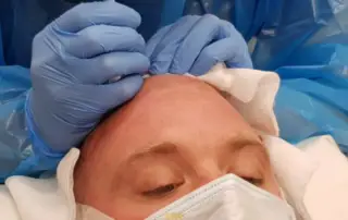 Did Peter “Tubes” Dale Have a Hair Transplant F