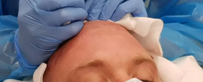 Did Peter “Tubes” Dale Have a Hair Transplant F