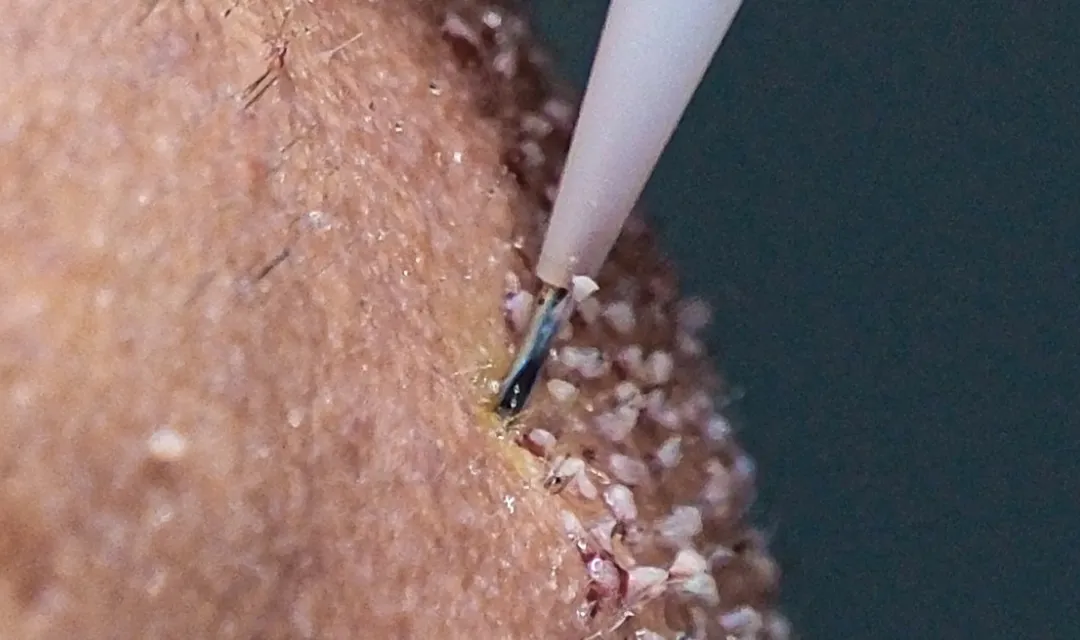 FUE DHI HAIR TRANSPLANT PROCESS FUE DHI HAIR TRANSPLANT PROCESS
