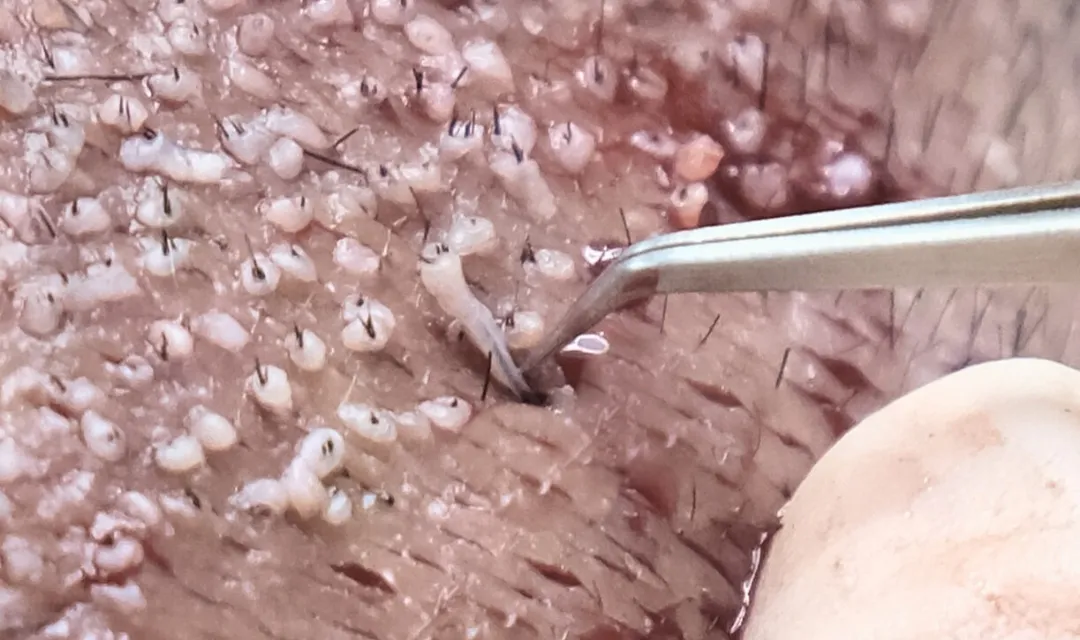 FUE SAPPHIRE HAIR TRANSPLANT PROCESS FUE SAPPHIRE HAIR TRANSPLANT PROCESS