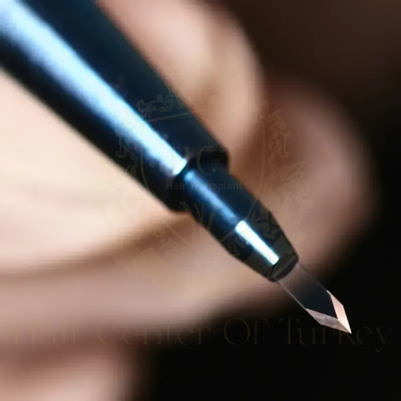 FUE Sapphire Technique 4