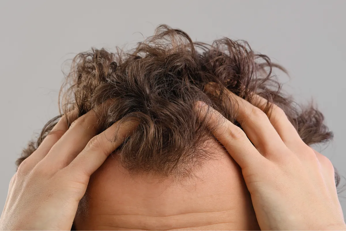 How Has Social Media Affected Our View on Hair Loss 2