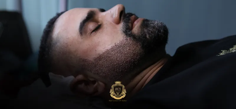 How Is a Beard Transplant Performed