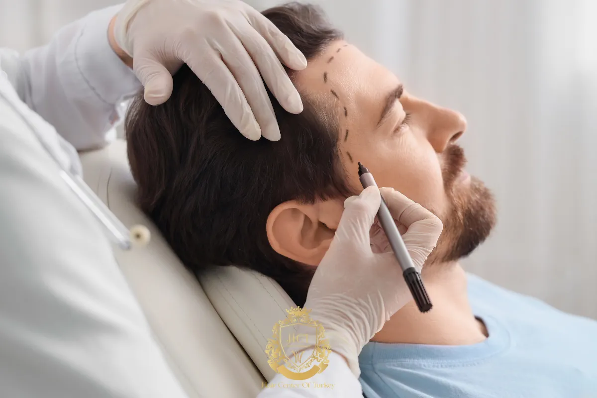Is Summer a Good Time for a Hair Transplant 2