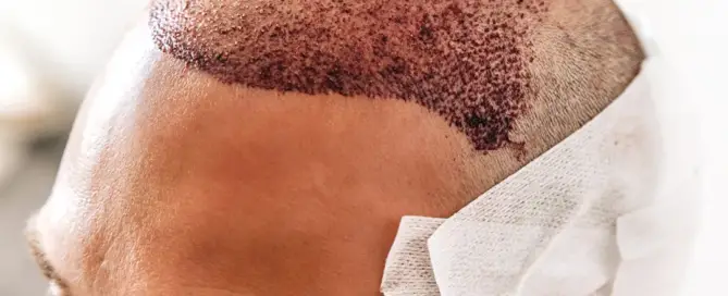 Is Summer a Good Time for a Hair Transplant F