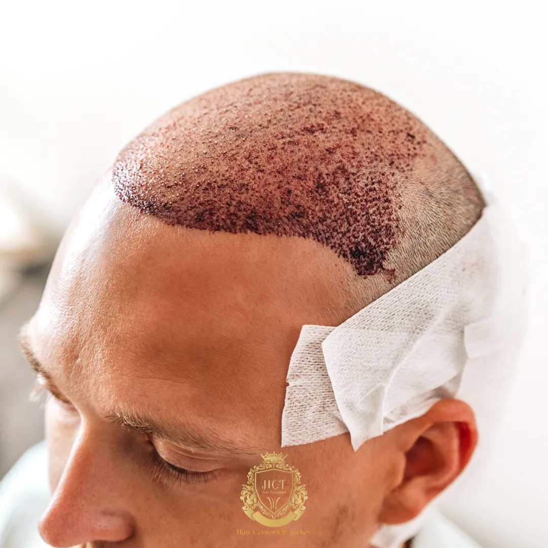 Is Summer a Good Time for a Hair Transplant F