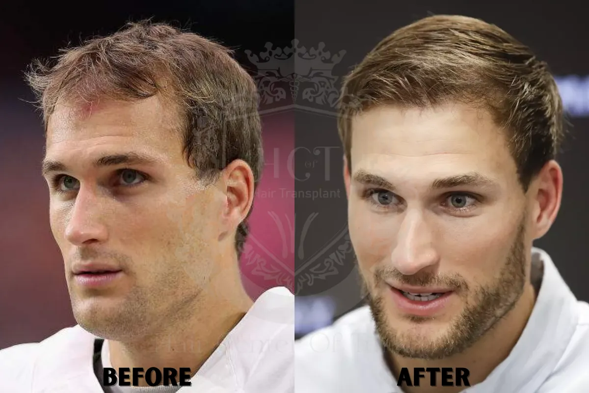 Did Kirk Cousins Get a Hair Transplant? 2