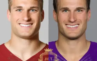 Did Kirk Cousins Get a Hair Transplant?