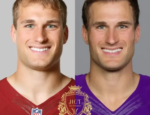 Heeft Kirk Cousins een haartransplantatie ondergaan?