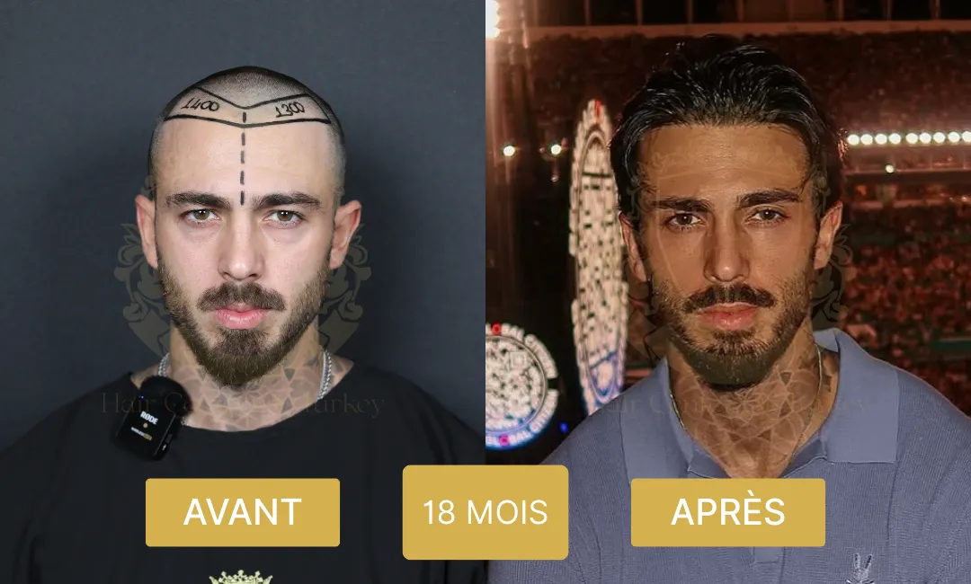 Résultats avant et après la greffe de cheveux au 18e mois