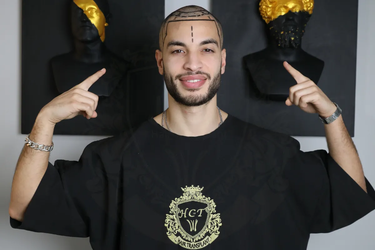 receding hairline