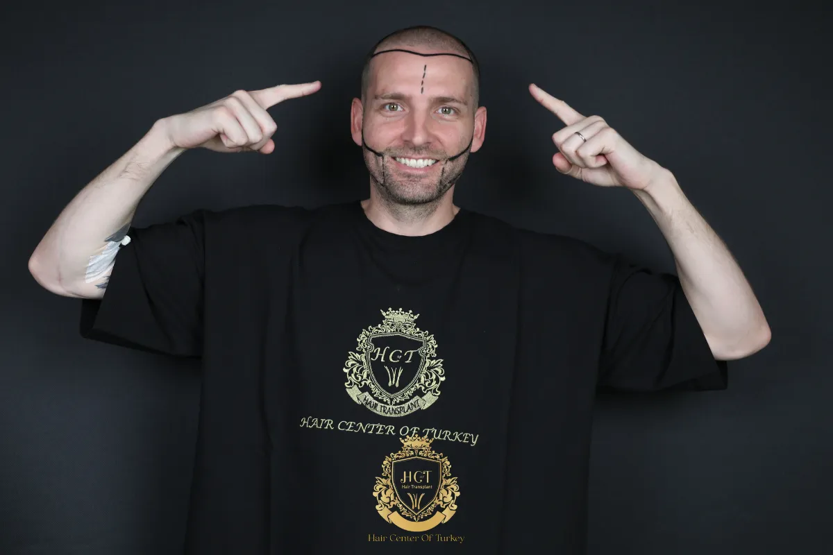 receding hairline