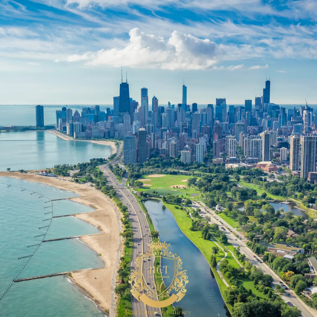 What Are the Best Hair Transplant Clinics in Chicago F