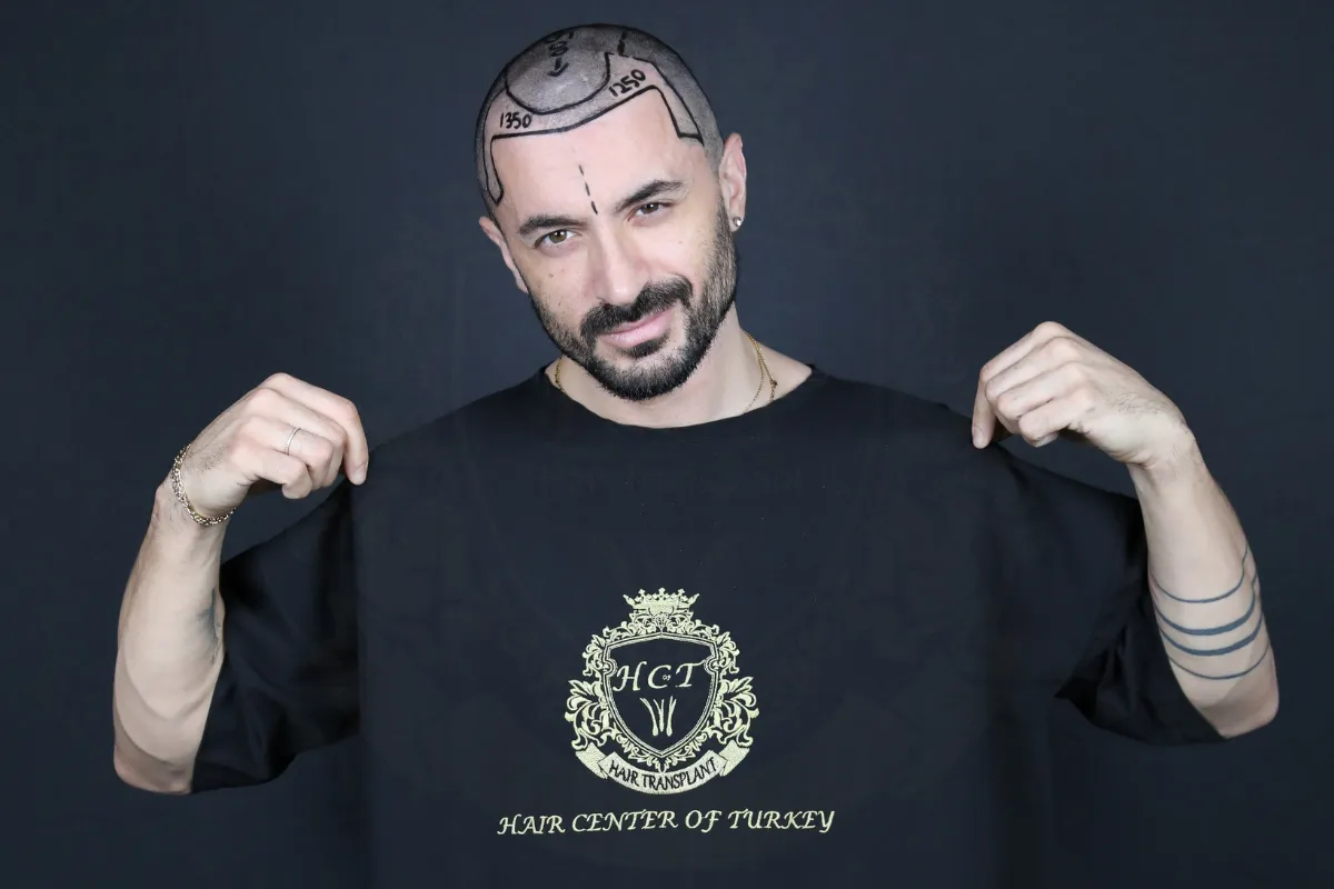 receding hairline
