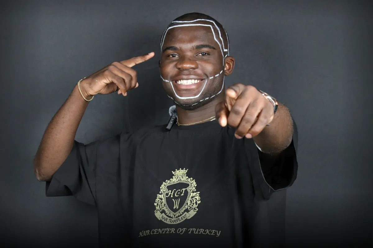 receding hairline