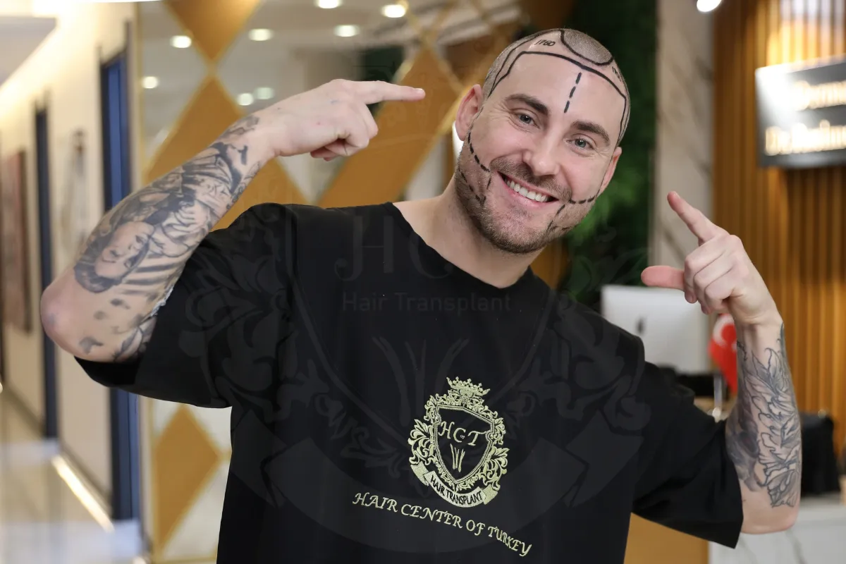 receding hairline