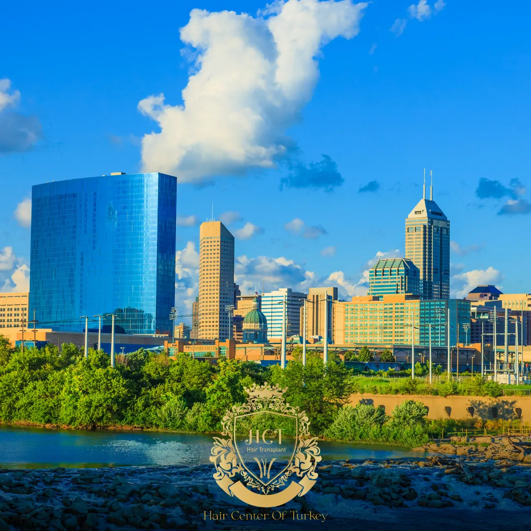 What Are the Best Hair Transplant Clinics in Indianapolis F