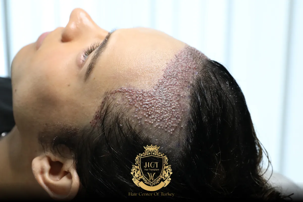 receding hairline