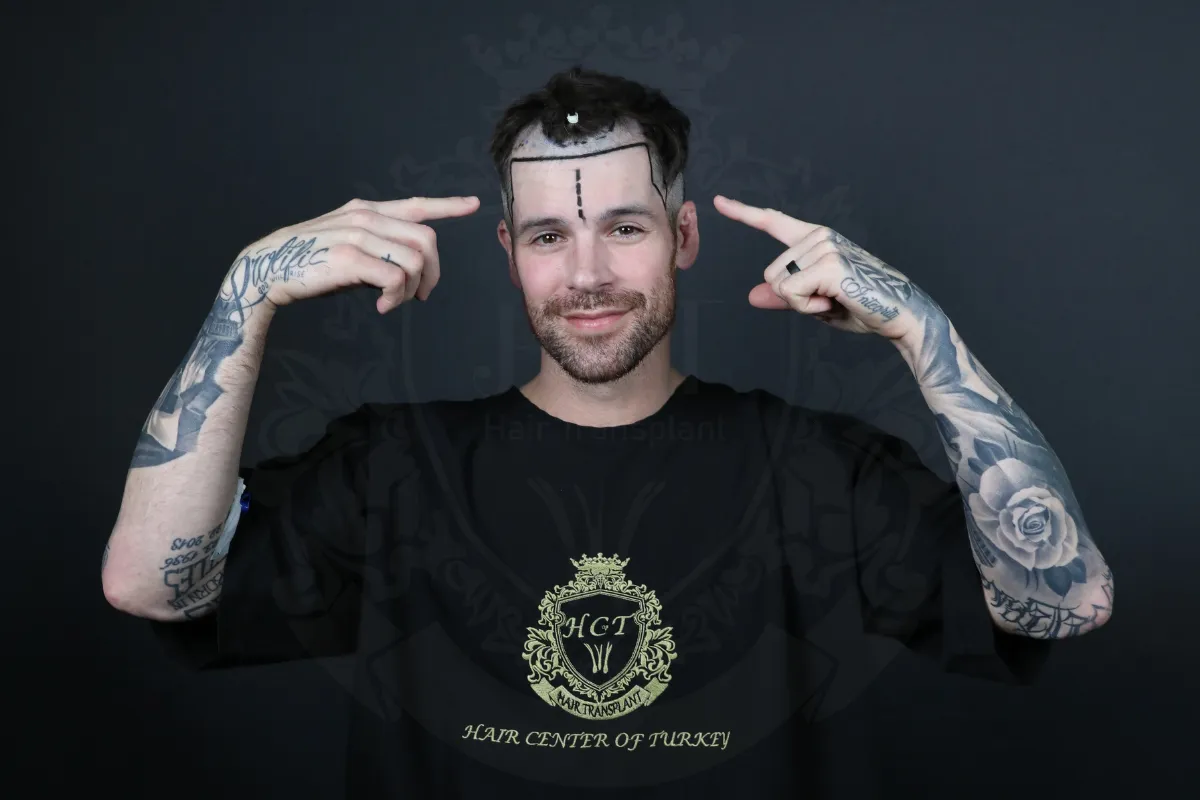 receding hairline