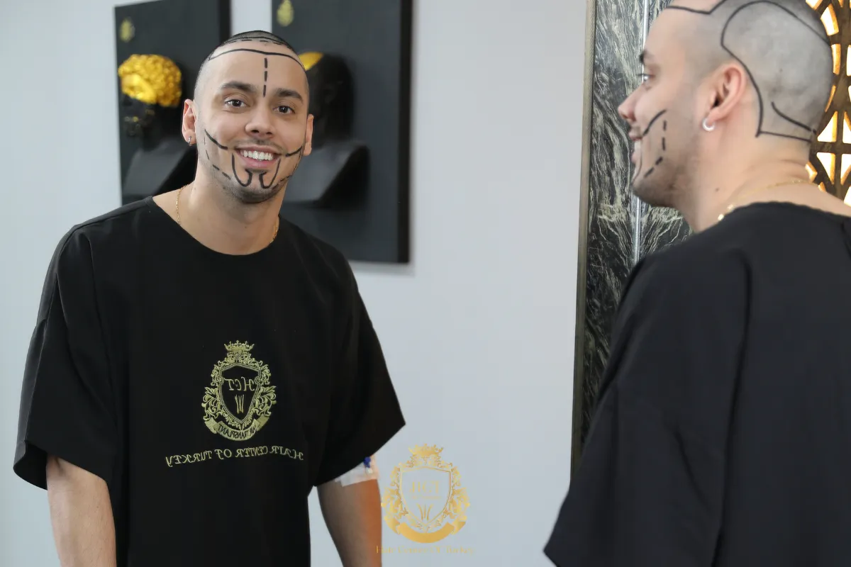 receding hairline