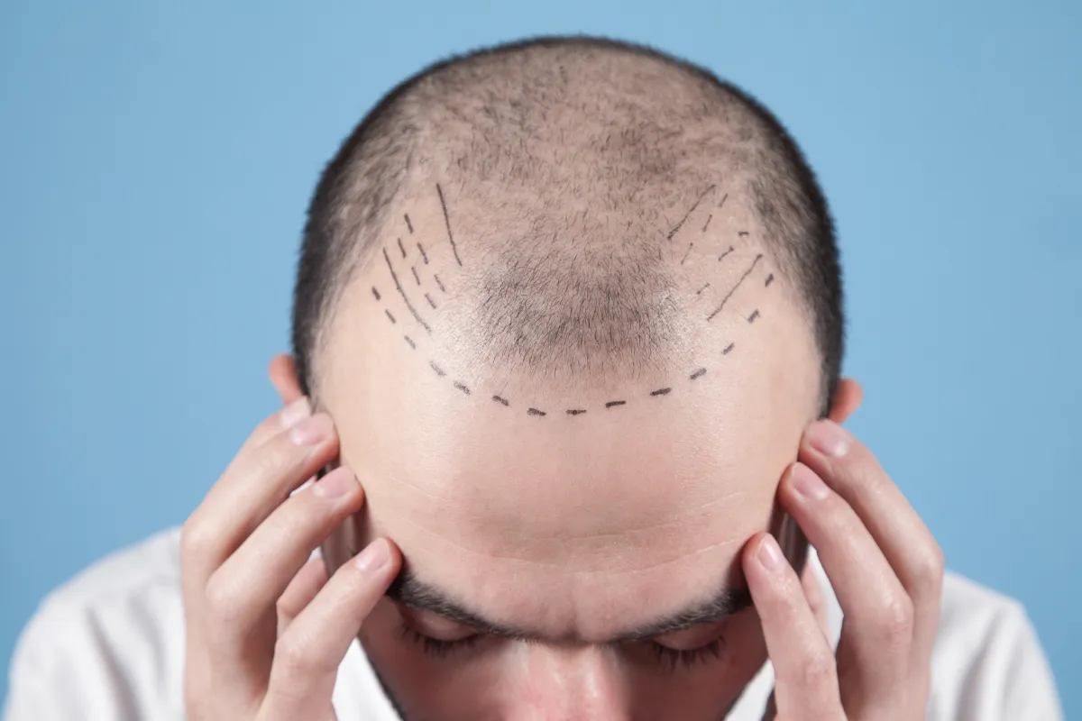 Which Is Better NeoGraft or FUE 2