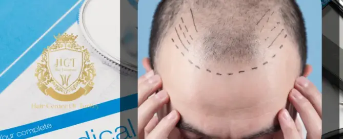 Will My Insurance Cover the Cost of a Hair Transplant F