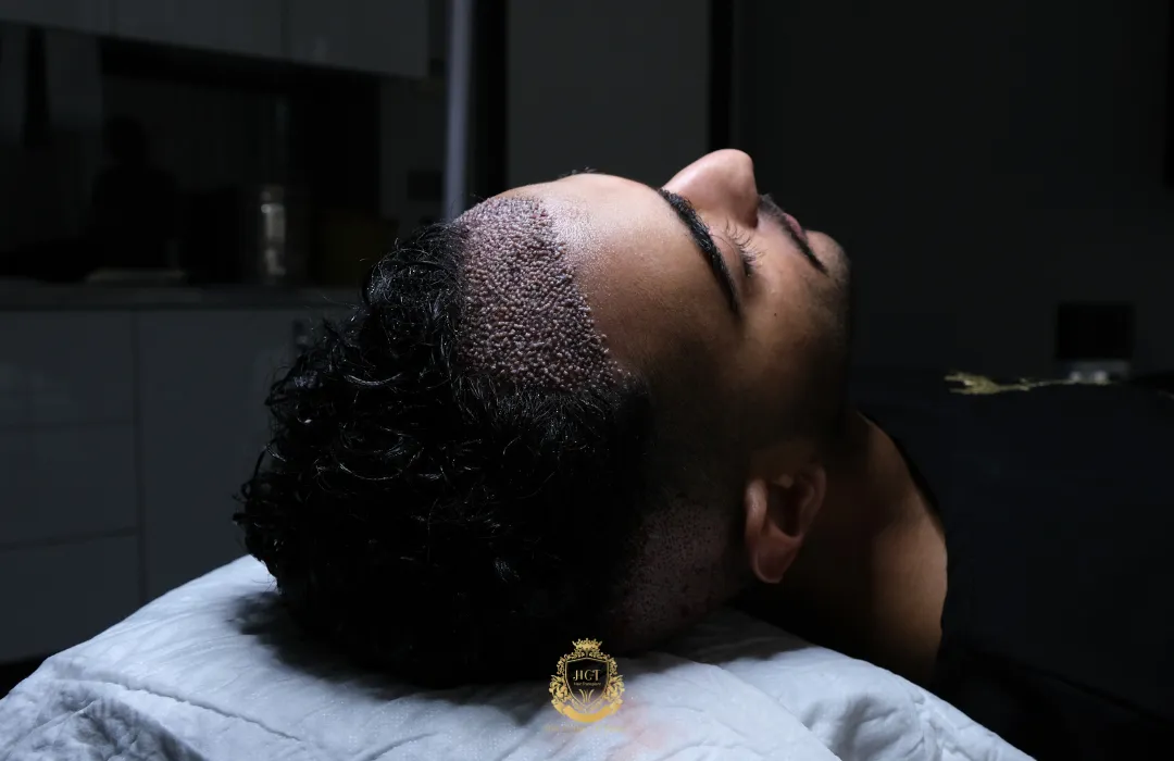 best value for your hair transplant in turkey