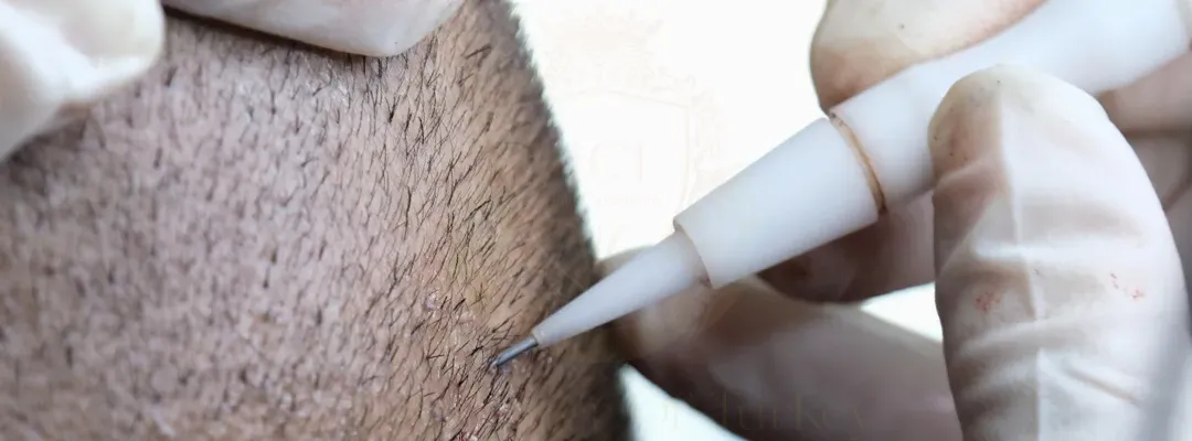 dhı-hair-transplant-1