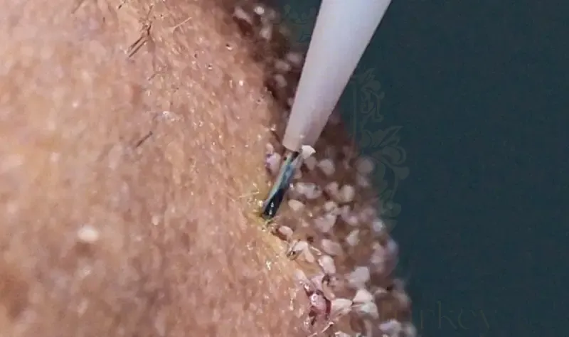 dhı-hair-transplant-4